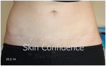 Surgical scar after dry tattooing